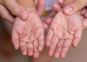 Kızamık alarmı: İngiltere’de iki çocuk hayatını kaybetti